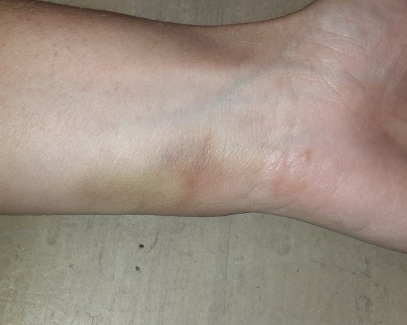 36 becca weird bruise